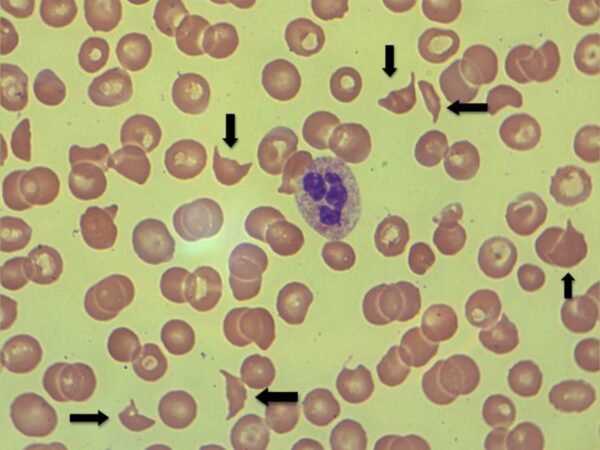 HAEMOLYTIC PROFILE